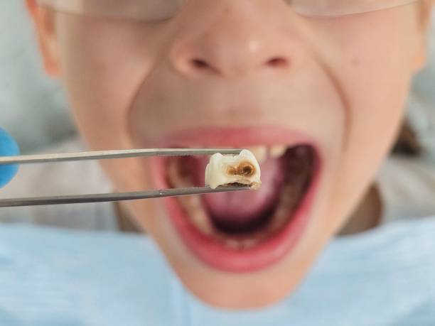 Best Emergency Wisdom Teeth Removal in Olive Branch, MS